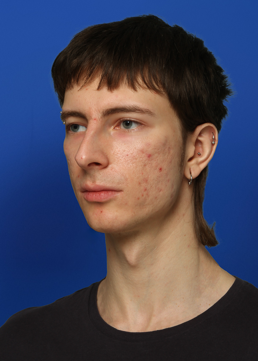 After Rhinoplasty - Front View